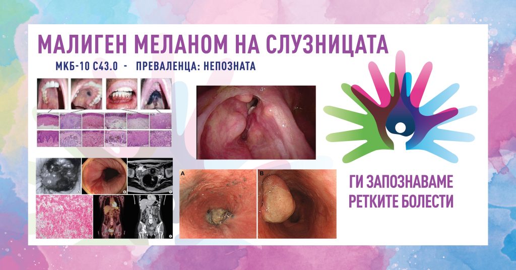 Ги запознаваме ретките болести: Малиген меланом на слузницата