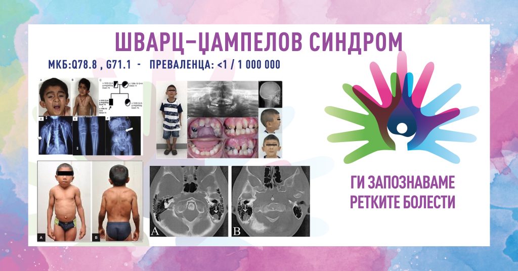 Ги запознаваме ретките болести: Шварц-Џампелов синдром Ги запознаваме ретките болести: Шварц-Џампелов синдром