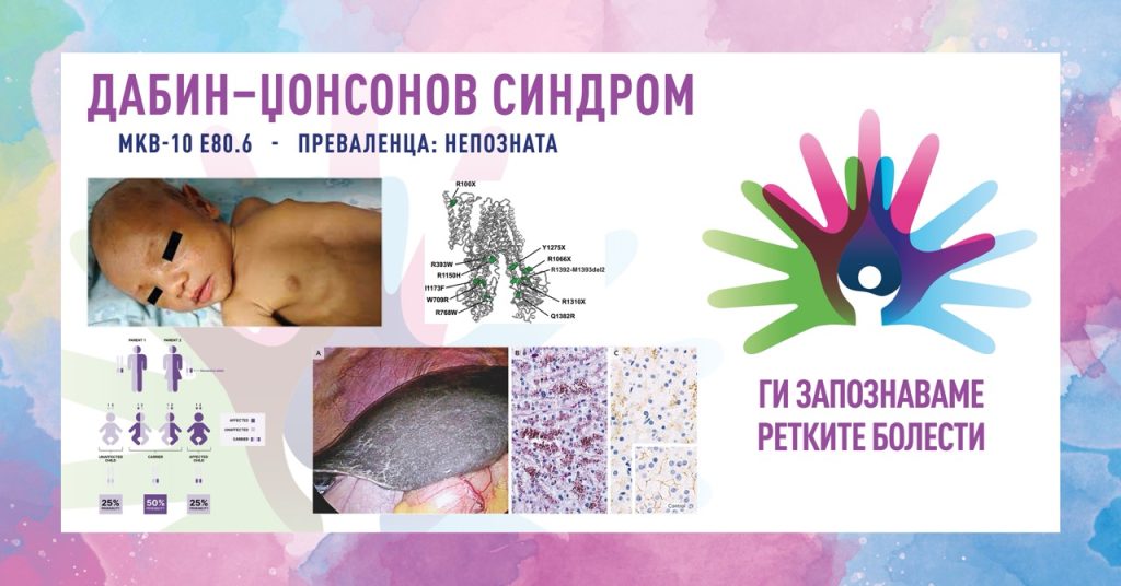 Ги запознаваме ретките болести: Дабин-Џонсонов синдром Ги запознаваме ретките болести: Дабин-Џонсонов синдром