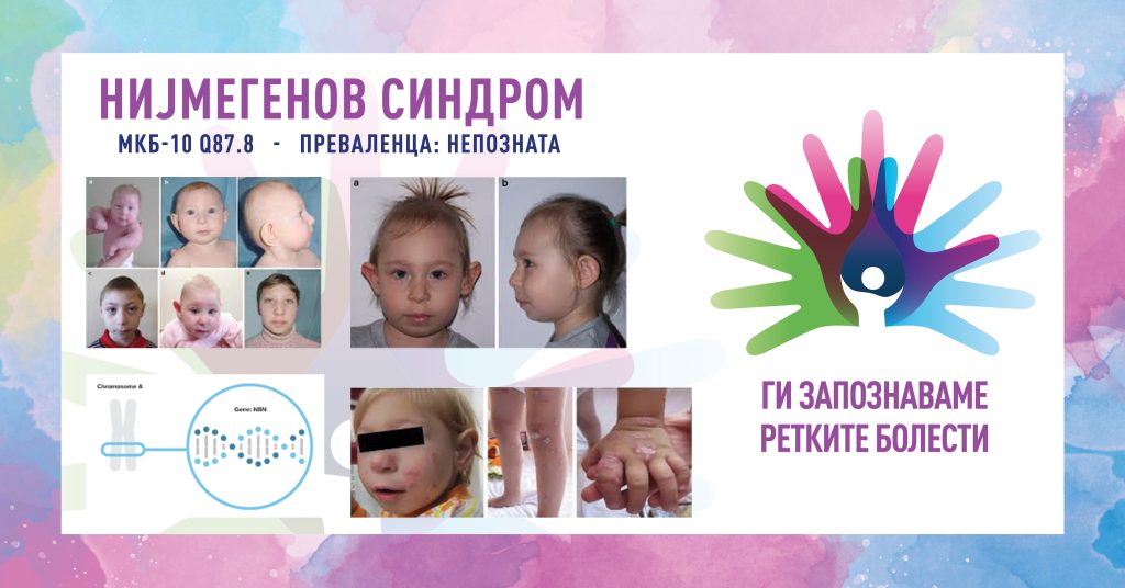 Ги запознаваме ретките болести: Нијмегенов синдром Ги запознаваме ретките болести: Нијмегенов синдром