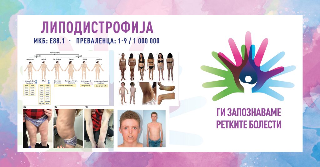 Ги запознаваме ретките болести: Липодистрофија