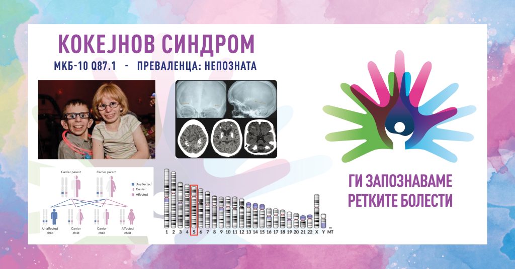 Ги запознаваме ретките болести: Кокејнов синдром