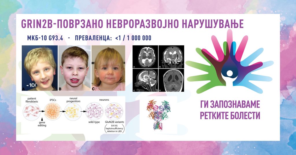 Ги запознаваме ретките болести: GRIN2B-Поврзано невроразвојно нарушување