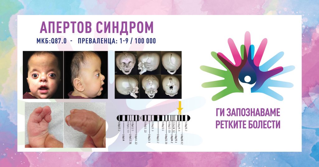 Ги запознаваме ретките болести: Апертов синдром
