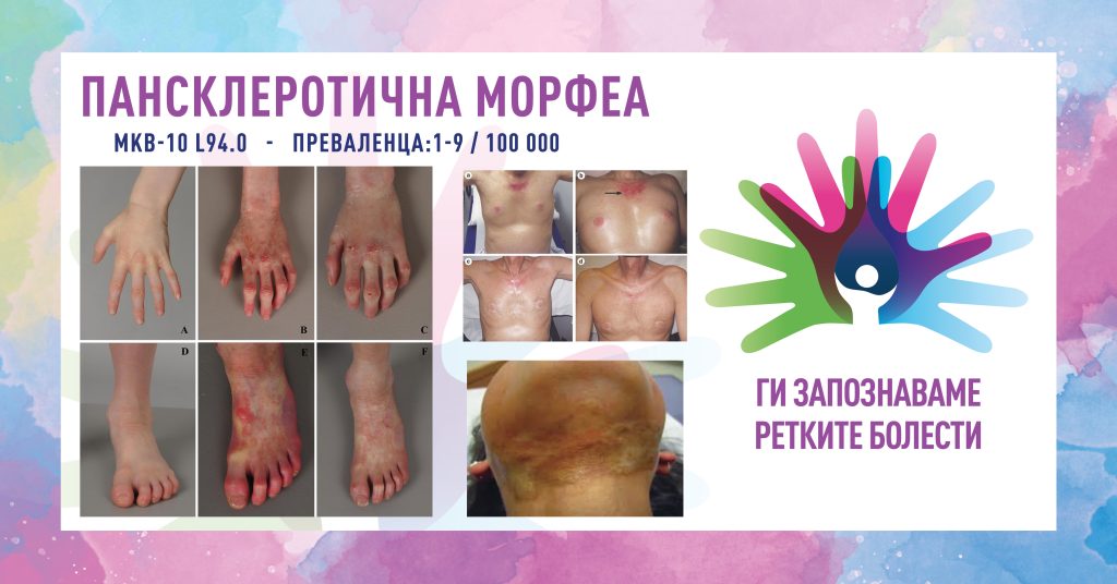 Ги запознаваме ретките болести: Пансклеротична морфеа