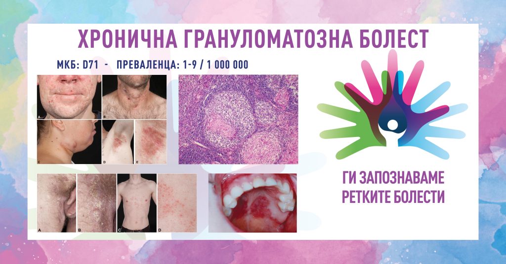 Ги запознаваме ретките болести: Хронична грануломатозна болест (ХГБ)