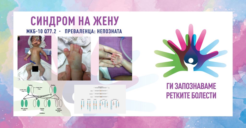 Ги запознаваме ретките болести: Синдром на Жену Ги запознаваме ретките болести: Синдром на Жену