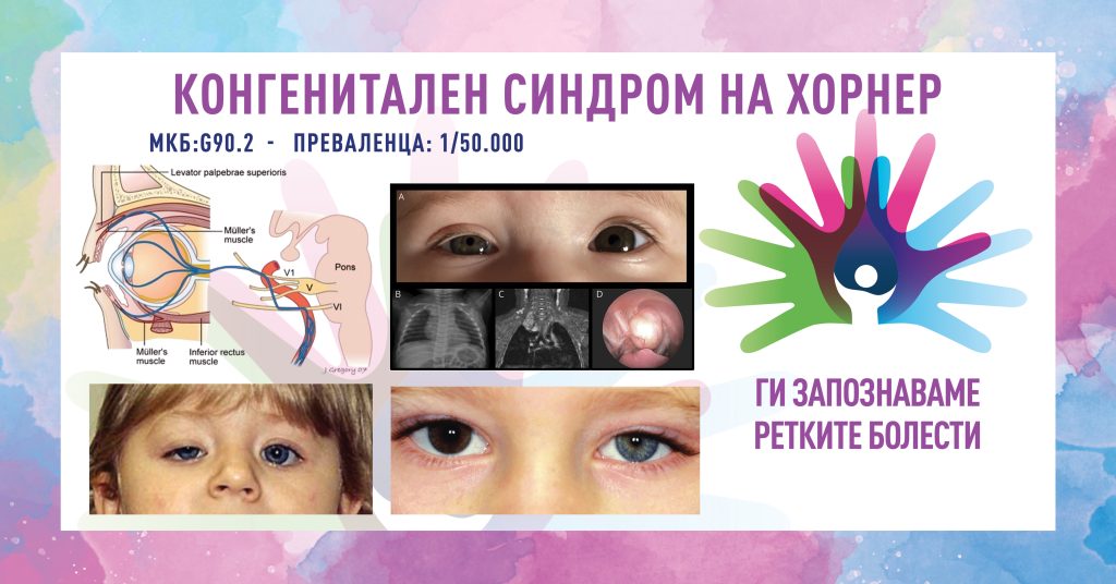 Ги запознаваме ретките болести: Конгенитален синдром на Хорнер Ги запознаваме ретките болести: Конгенитален синдром на Хорнер