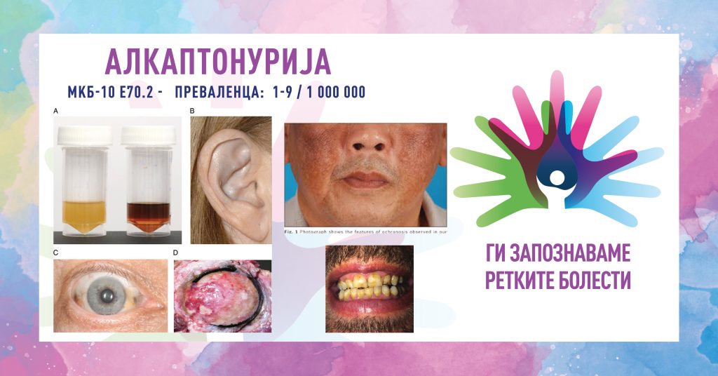 Ги запознаваме ретките болести: Алкаптонурија Ги запознаваме ретките болести: Алкаптонурија