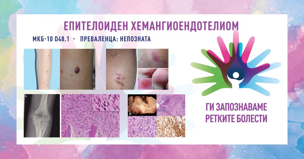 Ги запознаваме ретките болести: Епителоиден хемангиоендотелиом (ЕХЕ) Ги запознаваме ретките болести: Епителоиден хемангиоендотелиом (ЕХЕ)