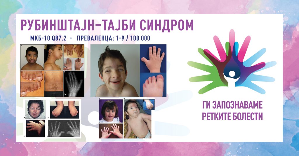 Ги запознаваме ретките болести: Рубинштајн-тајби синдром Ги запознаваме ретките болести: Рубинштајн-тајби синдром