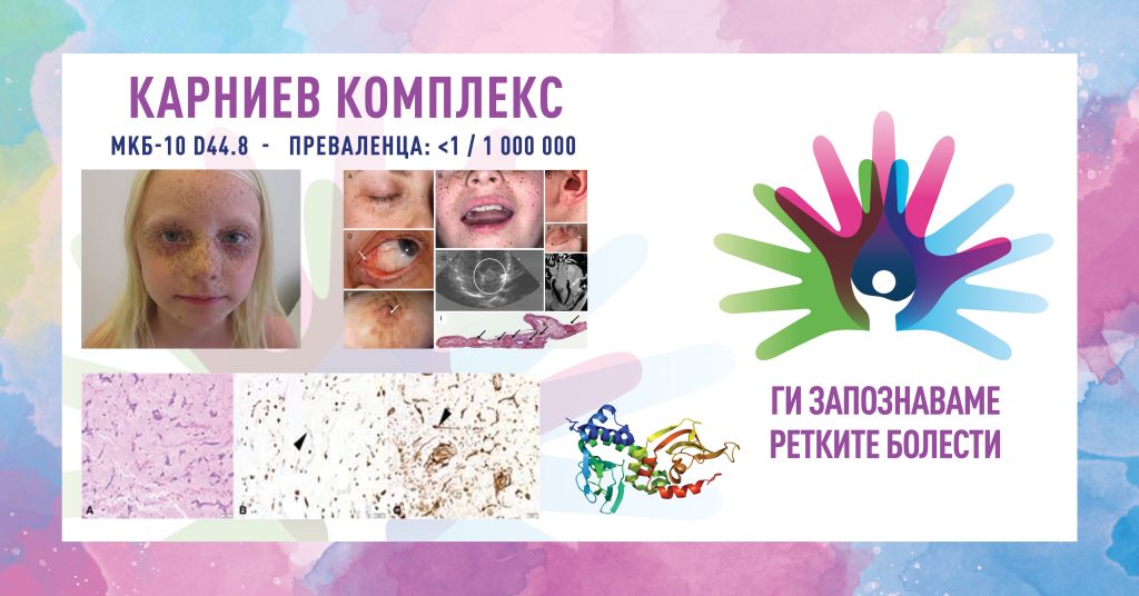 Ги запознаваме ретките болести: Карниев комплекс Ги запознаваме ретките болести: Карниев комплекс