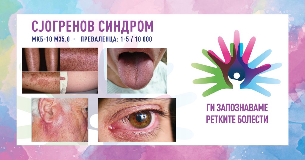 Ги запознаваме ретките болести: Сјогренов синдром Ги запознаваме ретките болести: Сјогренов синдром